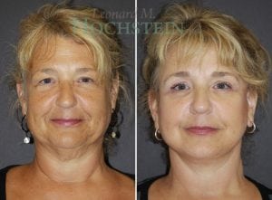 Facelift Patient