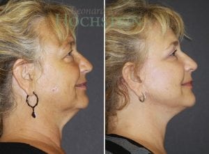 Facelift Patient