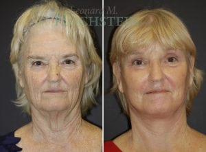 Facelift Patient