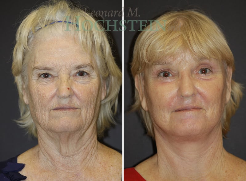 Facelift Patient