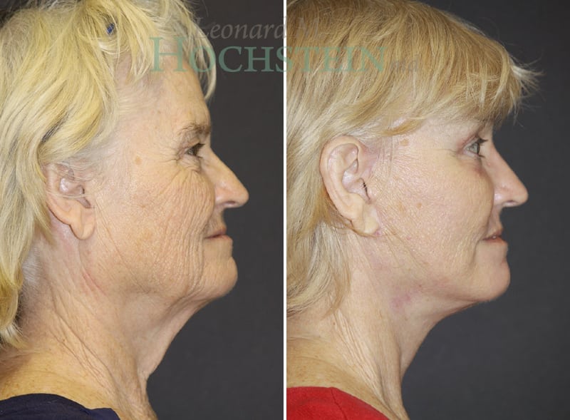 Facelift Patient