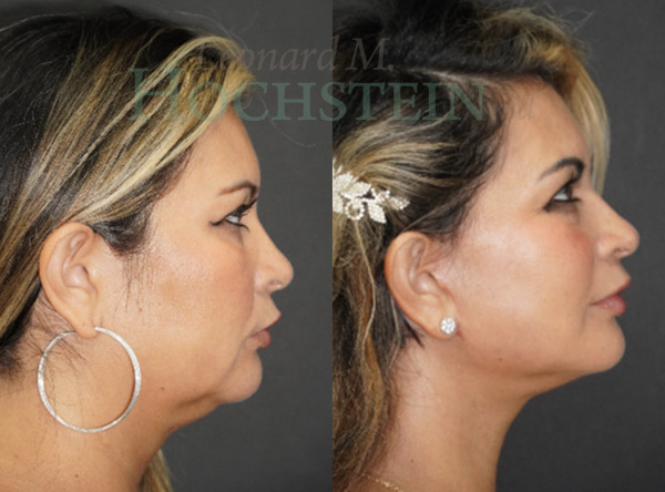 Facelift Patient