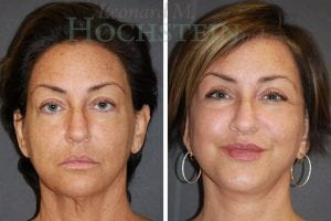 Facelift Patient