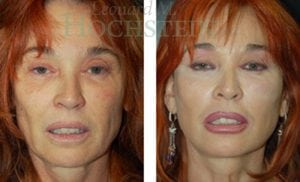 Facelift Patient