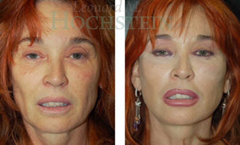 Facelift Patient