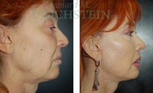 Facelift Patient