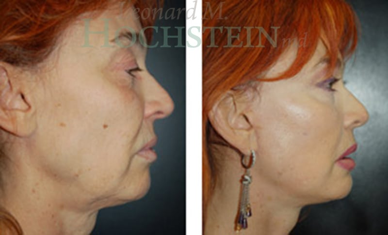 Facelift Patient