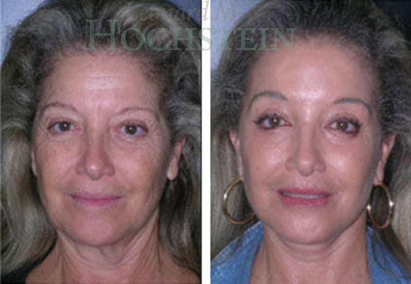 Facelift Patient