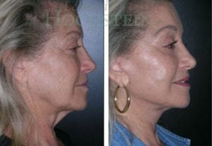 Facelift Patient