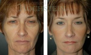 Facelift Patient
