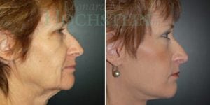 Facelift Patient