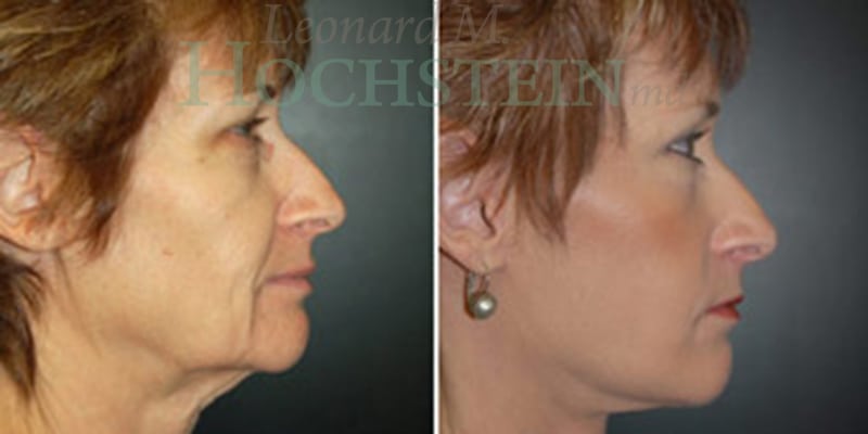 Facelift Patient