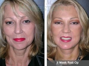Face Lift Patient 08