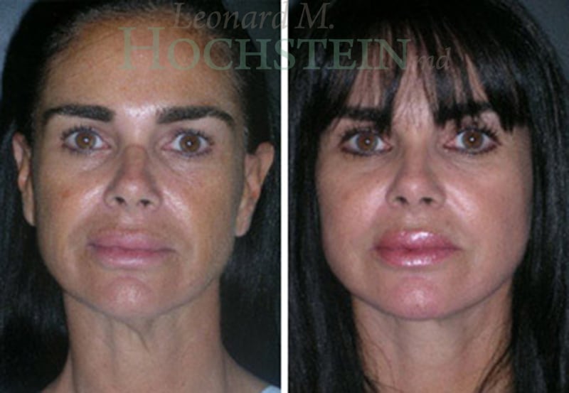 Facelift Patient
