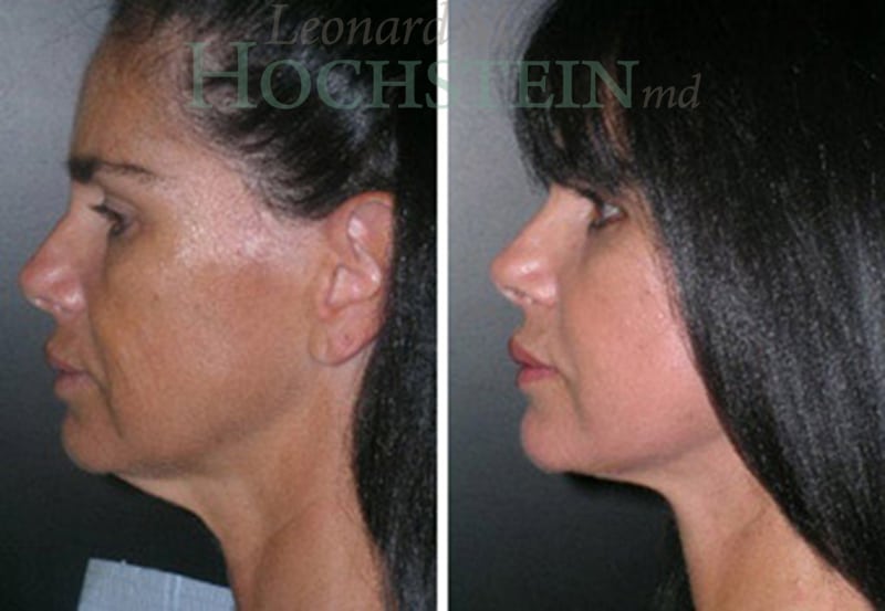 Facelift Patient