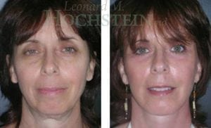 Facelift Patient