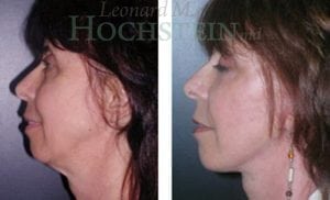 Facelift Patient