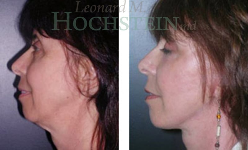 Facelift Patient