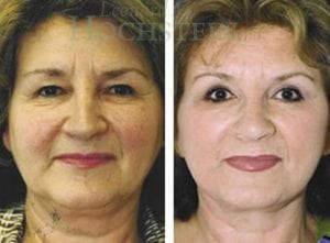 Facelift Patient
