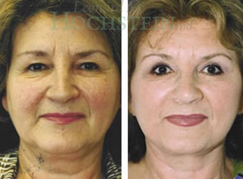 Facelift Patient