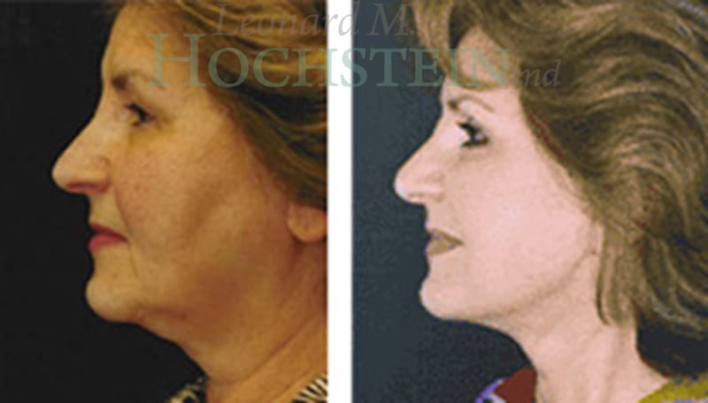 Facelift Patient