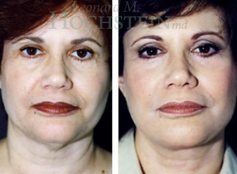 Facelift Patient