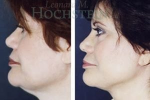 Facelift Patient