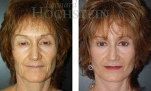 Facelift Patient