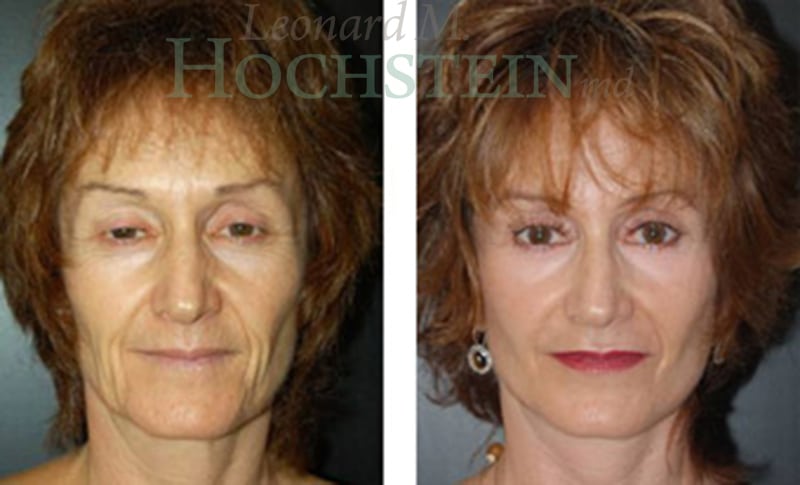 Facelift Patient