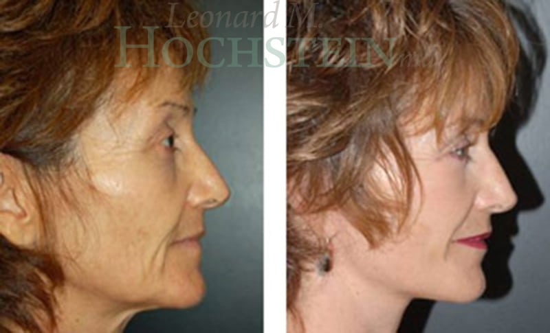 Facelift Patient