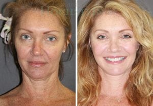 Facelift Patient