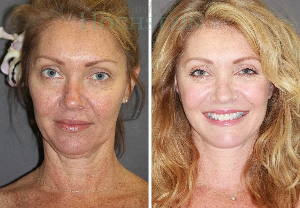Facelift Patient