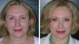 Facelift Patient