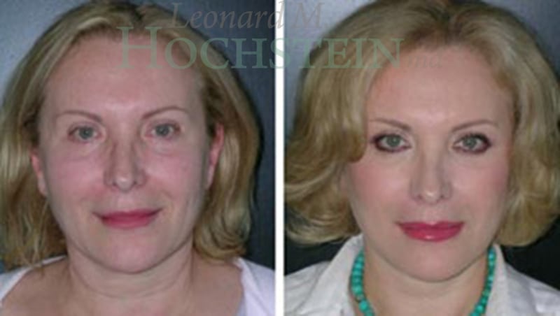 Facelift Patient