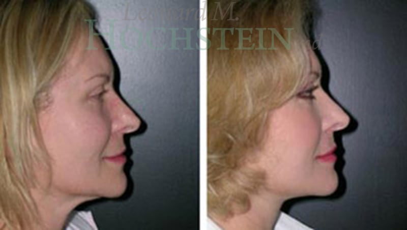 Facelift Patient