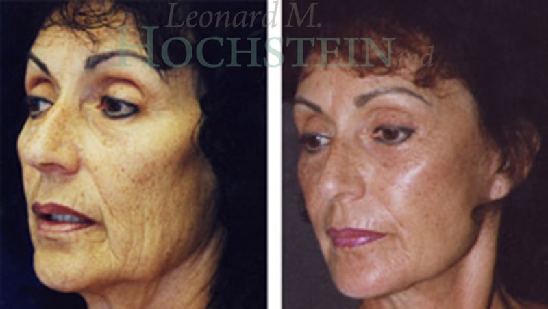 Facelift Patient