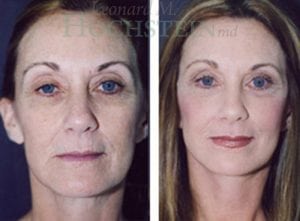 Facelift Patient
