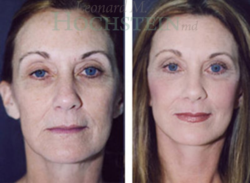 Facelift Patient