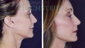 Facelift Patient