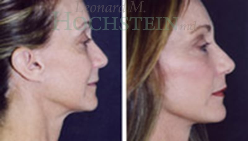 Facelift Patient