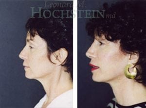Face Lift Patient 17