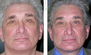 Face Lift Patient 18