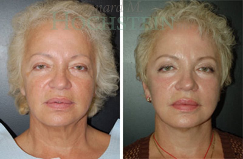 Facelift Patient