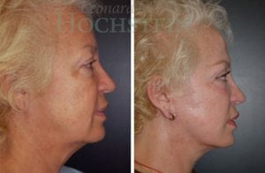 Facelift Patient