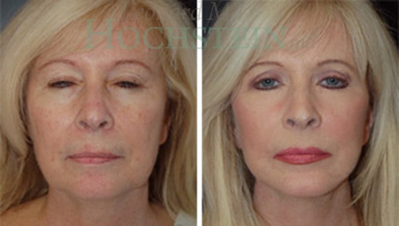 Facelift Patient