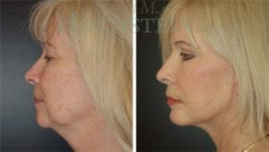 Facelift Patient