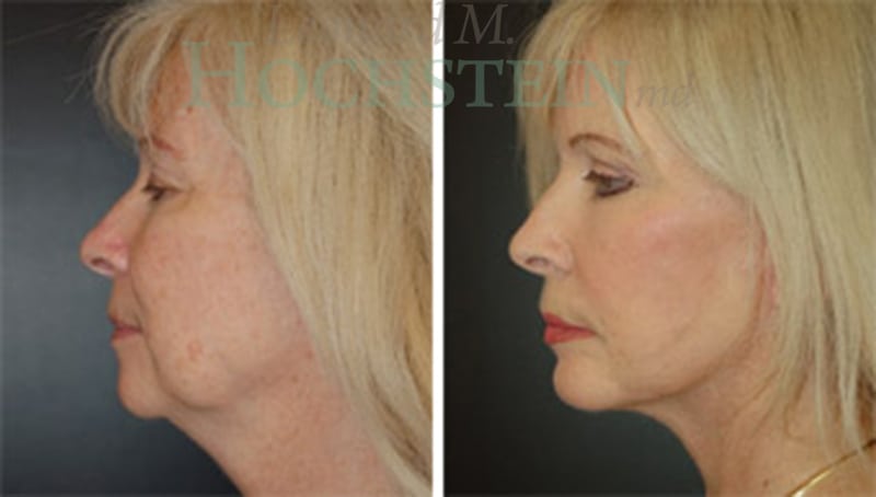 Facelift Patient