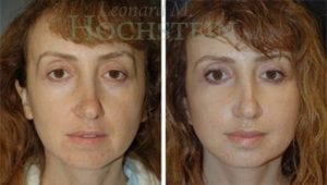 Facelift Patient