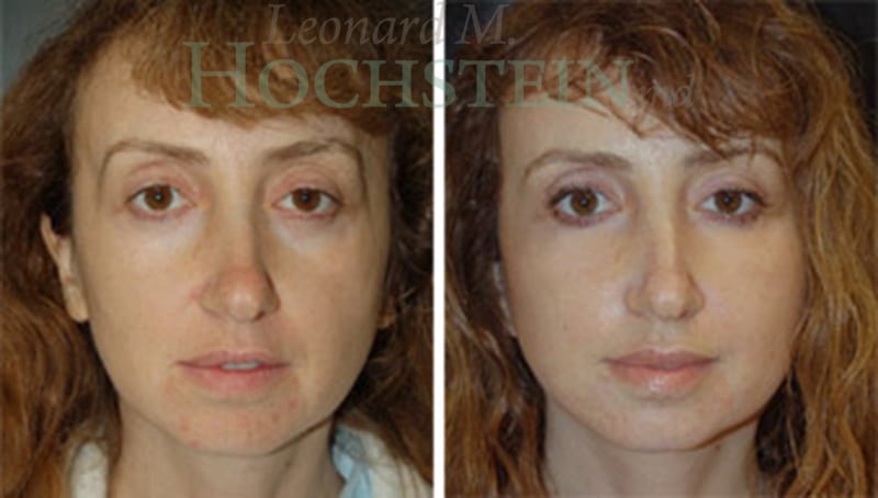 Facelift Patient