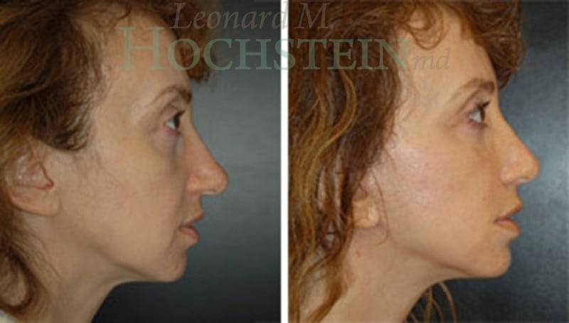 Facelift Patient